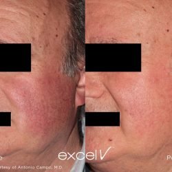 Before/After Laser Resurfacing Results